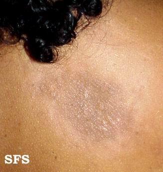 局限性硬皮病又称硬斑病,是一种限局性皮肤