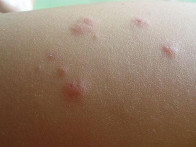 痤疮样梅毒疹 丘疹顶端形成脓疱,散发全身,多见于中年,梅毒血清反应为