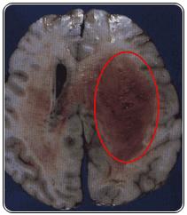脑胶质瘤_脑胶质瘤症状_脑胶质瘤能活多久 | 知客分享
