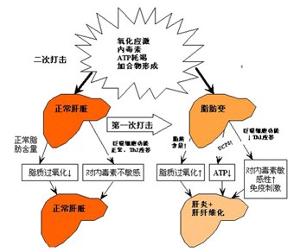 老年人酒精性肝病
