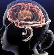 颅内压增高综合症