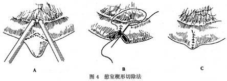 梅克尔憩室