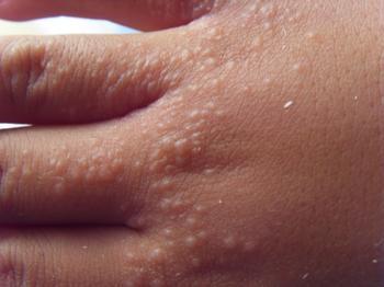 沙土皮炎医学上称为幼儿丘疹性皮炎,磨擦性苔癣样疹,好发于3至10岁的