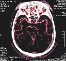 ct血管造影