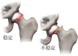 骨头错位