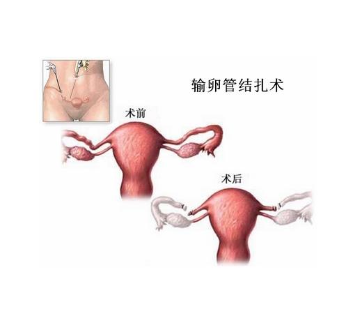<em>女性结扎</em>,为输卵管绝育术的一种