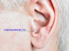 超小型助听器是完全植入式助听器埋入头部皮下组织中