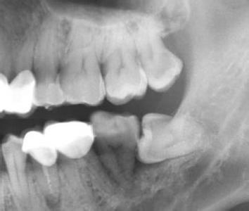 因此,为了预防干槽症的发生,在拔牙过程中应尽量减少创伤,拔牙后应