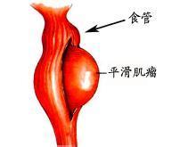 食管良性肿瘤