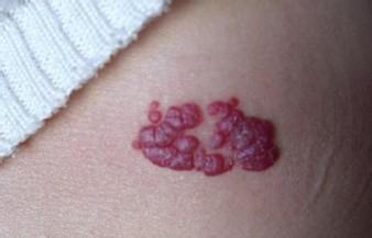 koposi肉瘤血管纤维瘤和血管脂肪瘤鉴别根据鲜红色或紫红色角化丘疹