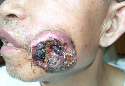  颊癌(carcinoma of the buccal mucosa)也是常见的口腔癌之一