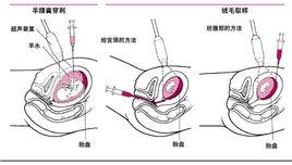 绒毛取样