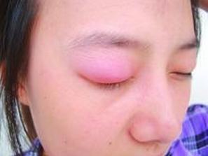 造成眼睑水肿的原因有很多,但都是发生在毛细血管损伤的基础上.