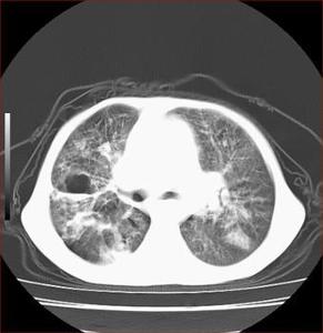 肝内脂肪浸润是什么意思