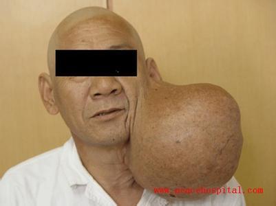 涎腺混合瘤为口腔颌面部最常见的肿瘤之一.来源于涎腺上皮.