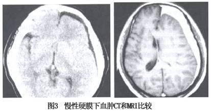 慢性硬脑膜下血肿