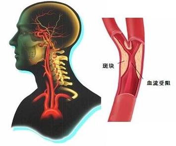 包括医学上常常提到的脑动脉粥样硬化(大,中动脉),小动脉硬化,微小