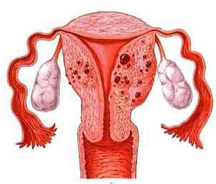 子宫肌腺症是什么原因造成的?