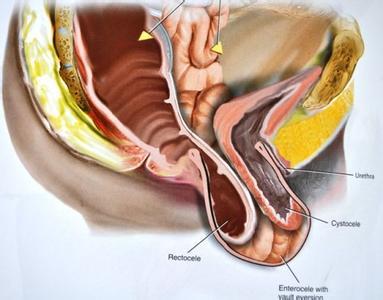 阴道后壁脱垂主要是由于耻骨尾骨肌纤维断裂所致,包括直肠膨出