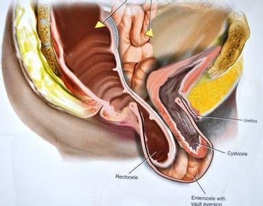 阴道后壁脱垂
