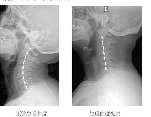 或是长时间的劳累,颈椎缺少