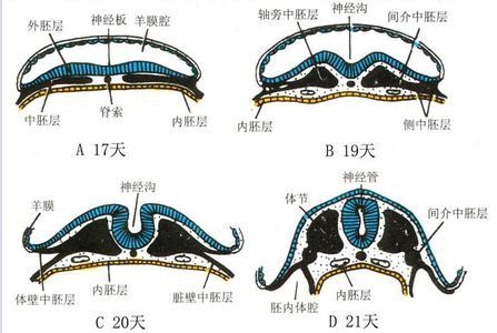 神经管畸形