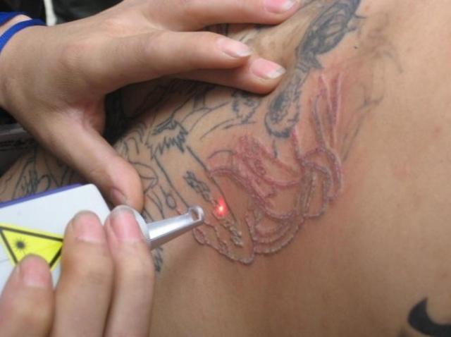 现在常用的洗纹身的方法有法,法,法,手术切除法.
