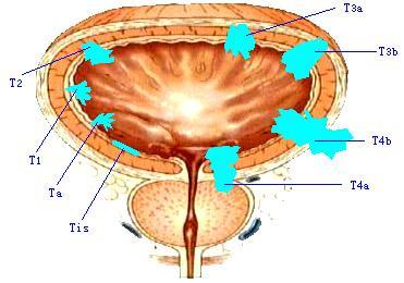 膀胱肿瘤+-+搜狗百科