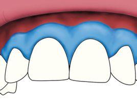 搜狗百科 牙龈(gingiva):牙龈是附着在牙颈和牙槽突部分的粘膜组织