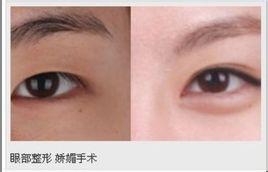 开内眼角,是一种整形手术,用于矫正小眼症,必须将内眦及外眦开大,必要