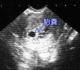 怀孕35天胎囊长到2.3*2.1*1.5cm正常吗