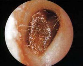 耳屎,是由外耳道耵聍腺分泌出的淡黄色粘稠液体遇空气干燥后形成的,有