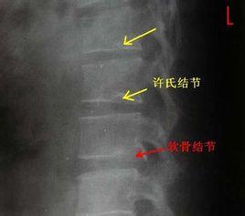 造成椎体内出现半圆形缺损阴影,称为许莫氏结节