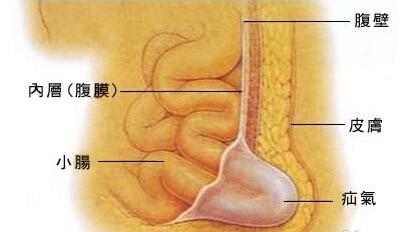 儿童疝气