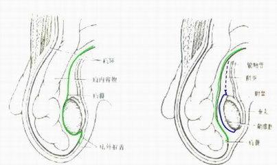 腹外疝