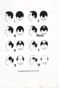 油脂性脱发