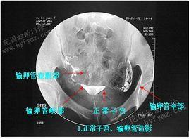 输卵管积液