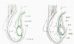 腹股沟疝:是指发生在腹股沟区的腹外疝,可分为腹股沟斜疝和腹股沟直疝