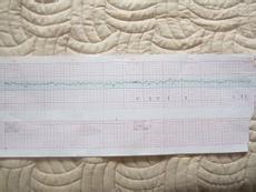 胎监是检查是否宫内缺氧的:胎心监护通过描绘20分钟内的胎动次数,每次