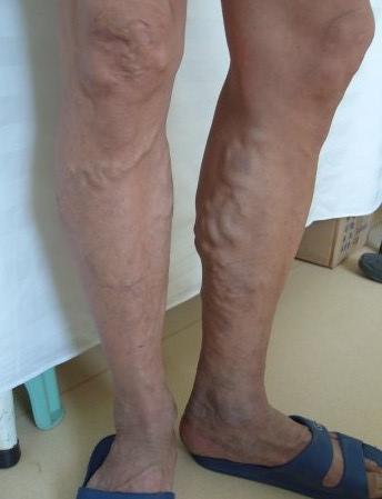 小腿静脉曲张+-+搜狗百科