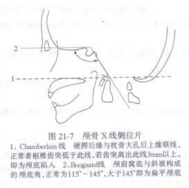 颅底陷入