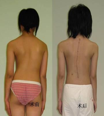 脊柱侧弯+-+搜狗百科