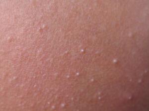 粟丘疹,又称称白色痤疮或粟丘疹白色苔藓,系起源于表皮或附属器上皮