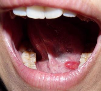 舌下囊肿