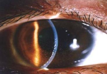 多发性硬化伴发葡萄膜炎