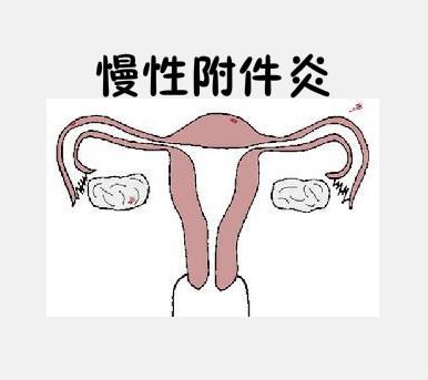 盆腔腹膜等处发生感染时的炎症的总称,慢性附件炎大多发生在产后,剖宫