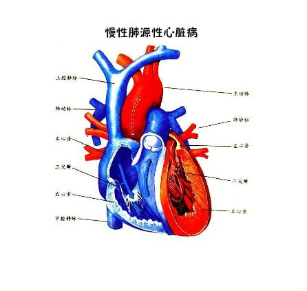 慢性肺源性心脏病