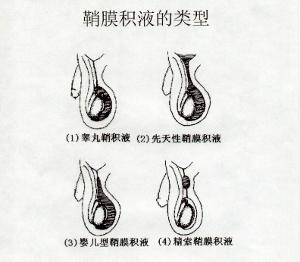 精索鞘膜积液