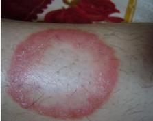 院 李小莎 身上长环妆疹子  荨麻疹可以排除,      1,风湿性环形红斑