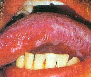 是艾滋病患者常见的口腔黏膜病变,又称口腔毛状黏膜白斑,口腔舌侧湿疣